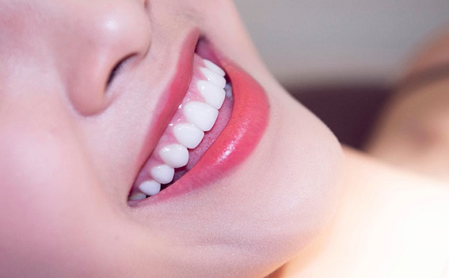 dan-rang-su-veneer