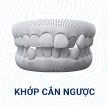 khớp cắn ngược