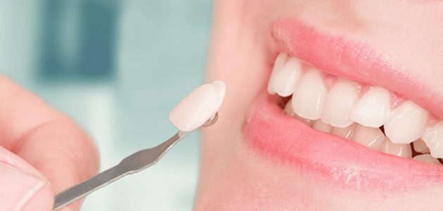 Quy trình dán răng sứ chuẩn bộ y tế tại nha khoa Home Dental