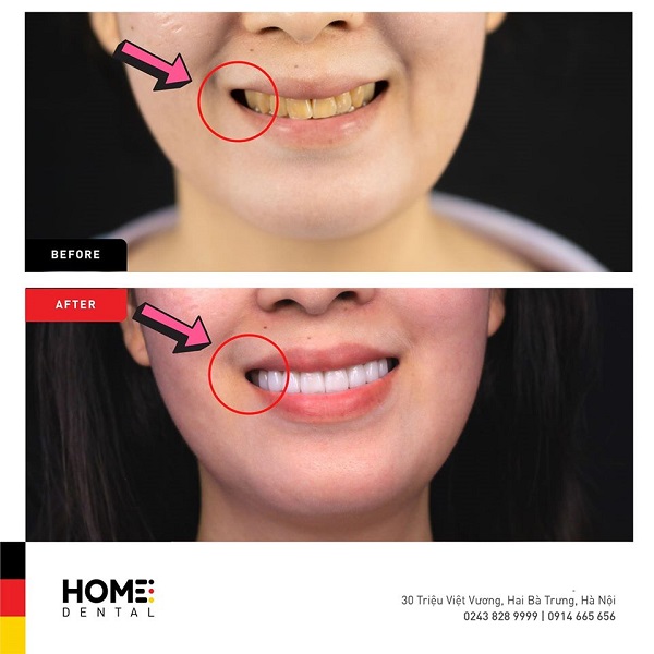 Tổng hợp một số câu hỏi thường gặp khi dán răng sứ Veneer