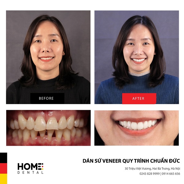 nha khoa Home - dán sứ veneer