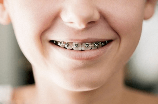 Thời gian "vàng" để niềng răng cho trẻ