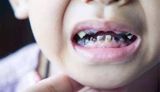 Cách chữa đau răng sâu ở trẻ em