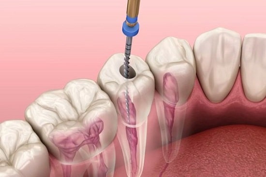 Cách điều trị răng tuỷ