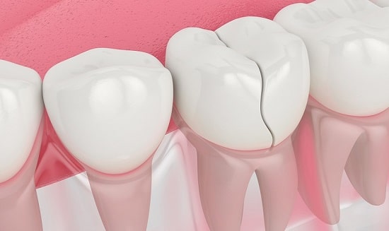 Bị nứt răng có nguy hiểm và có tự lành không?