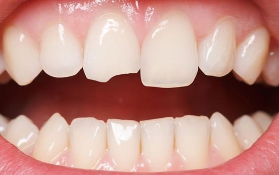 Cách phục hồi răng mẻ