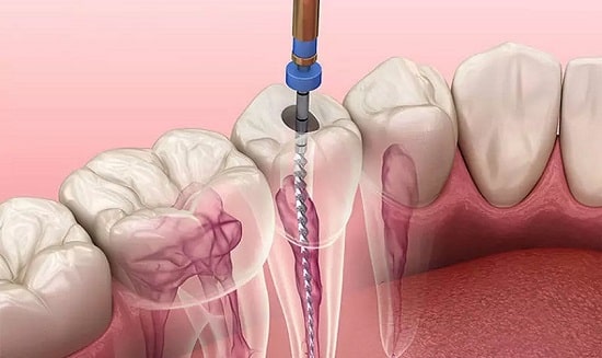 Quy trình lấy tủy răng