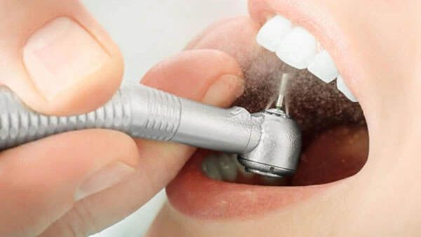 Dán sứ veneer có phải mài răng