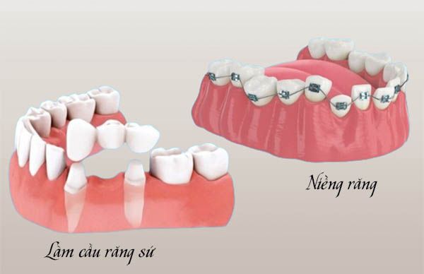 Làm cầu răng sứ niềng được không?