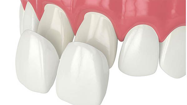 Nguyên nhân dán răng sứ veneer bị đau