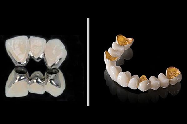 Tác hại răng sứ kim loại