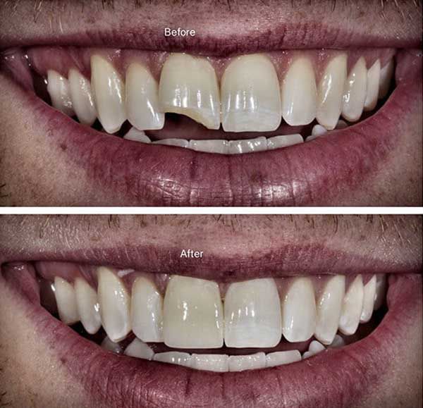 Trám răng cửa áp dụng cho trường hợp nào