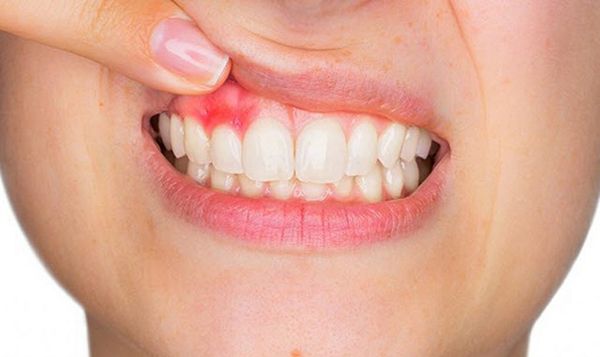 Viêm lợi là biến chứng bọc răng sứ