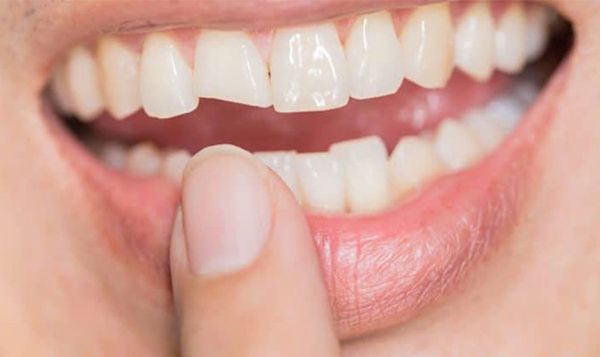 Vỡ mẻ răng sứ